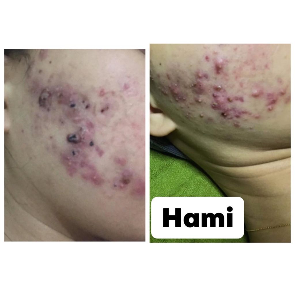 Bùng phát mụn khi điều trị bằng isotretioin