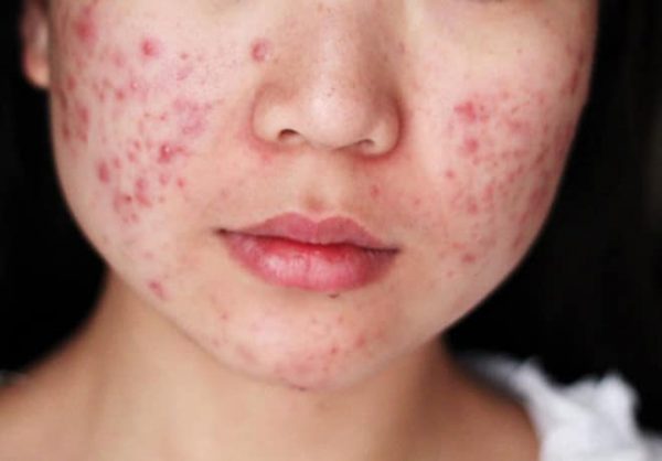 Một số chất có khả năng sinh cồi mụn và gây tắc nghẽn cơ học