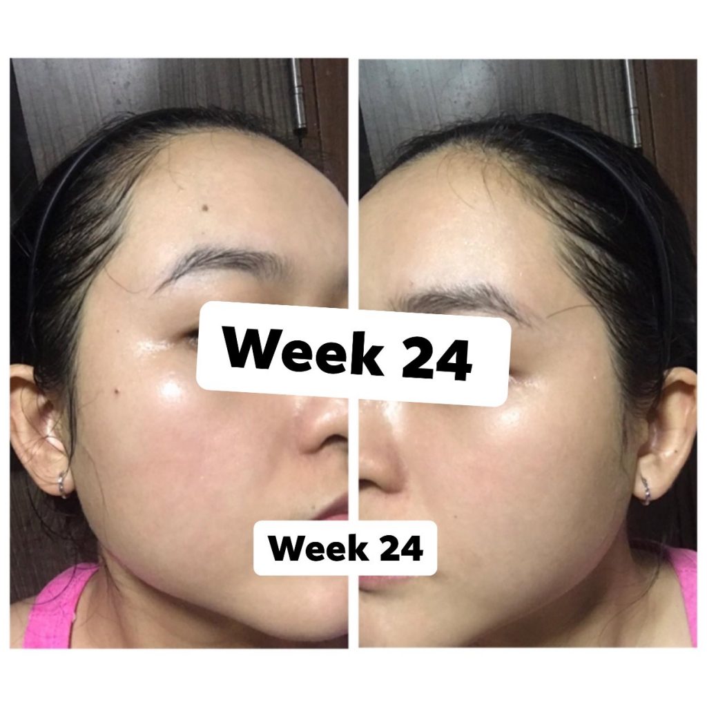 Bùng phát mụn khi điều trị bằng isotretioin