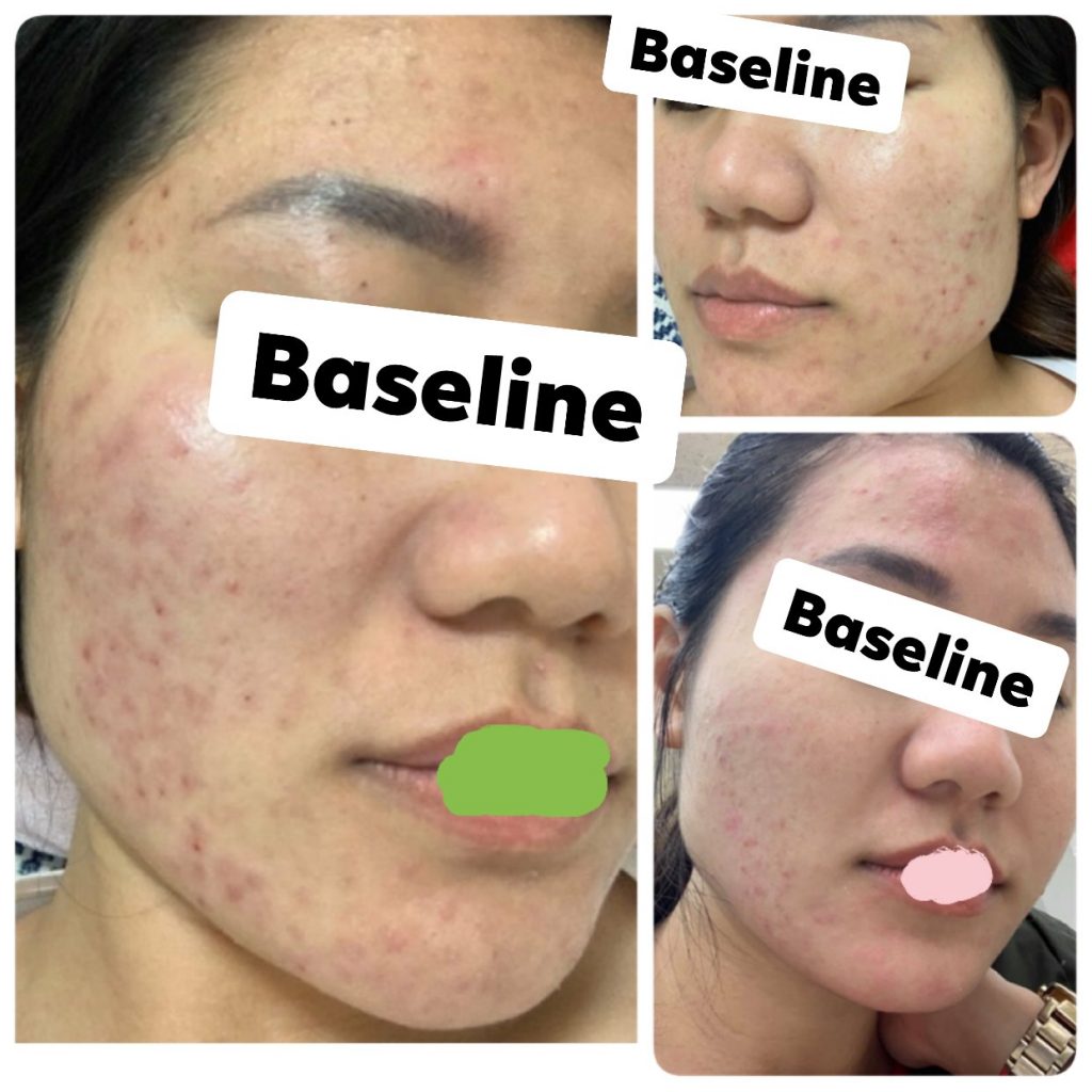 Bùng phát mụn khi điều trị bằng isotretioin